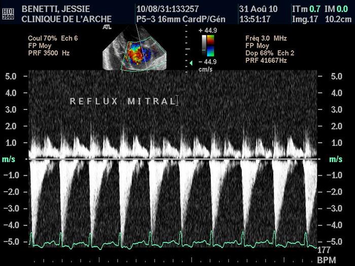 Analyse d'une regurgitation de la valve mitrale au doppler continu